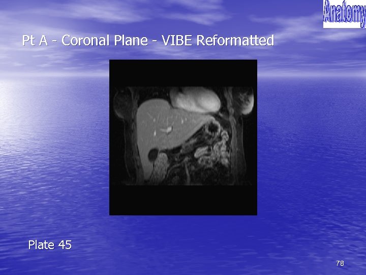 Pt A - Coronal Plane - VIBE Reformatted Plate 45 78 