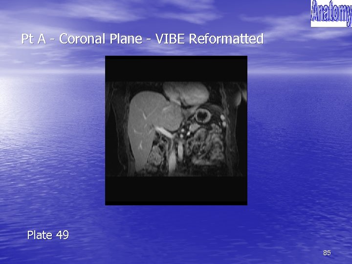 Pt A - Coronal Plane - VIBE Reformatted Plate 49 85 