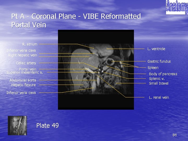 Pt A - Coronal Plane - VIBE Reformatted Portal Vein R. atrium Inferior vena