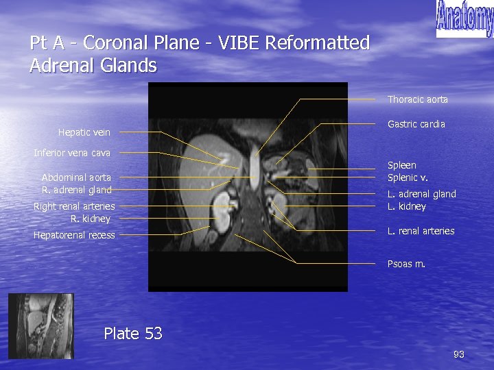 Pt A - Coronal Plane - VIBE Reformatted Adrenal Glands Thoracic aorta Hepatic vein