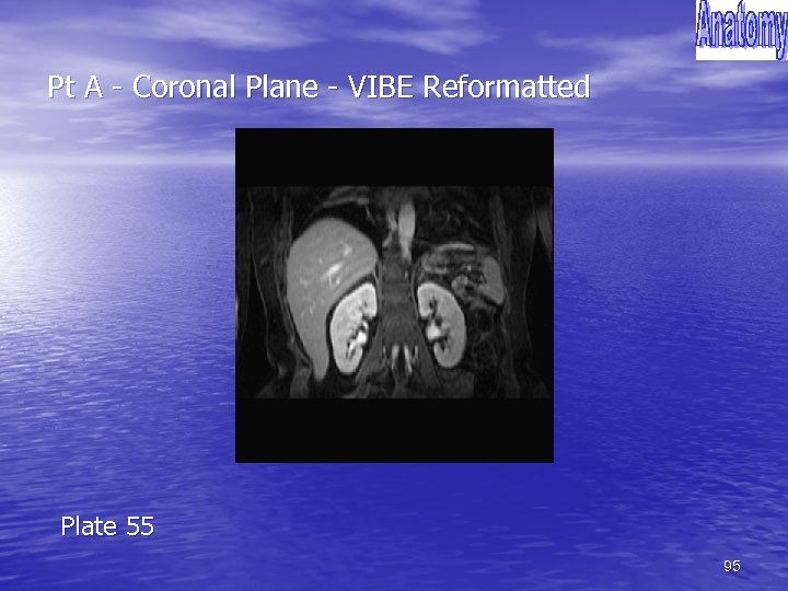 Pt A - Coronal Plane - VIBE Reformatted Plate 55 95 