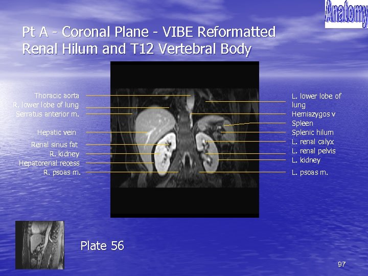 Pt A - Coronal Plane - VIBE Reformatted Renal Hilum and T 12 Vertebral