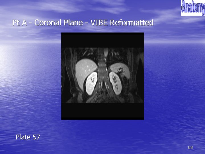 Pt A - Coronal Plane - VIBE Reformatted Plate 57 98 