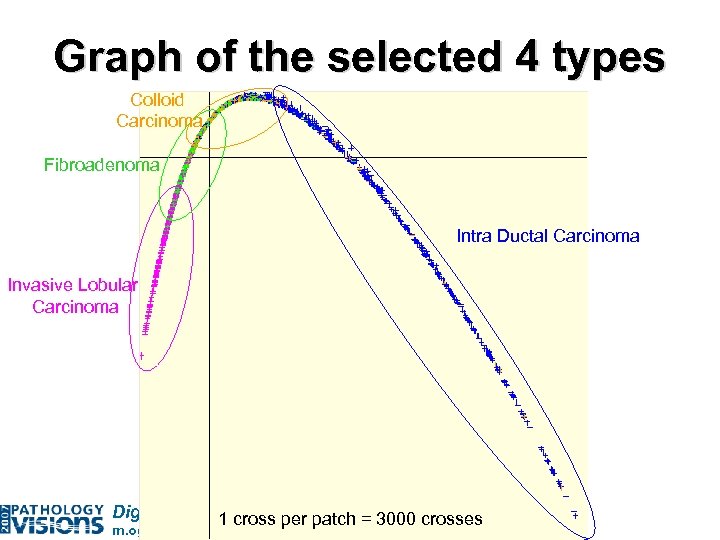 Graph of the selected 4 types Colloid Carcinoma Fibroadenoma Intra Ductal Carcinoma Invasive Lobular