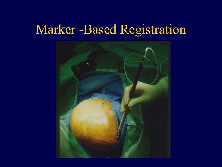 Marker -Based Registration 