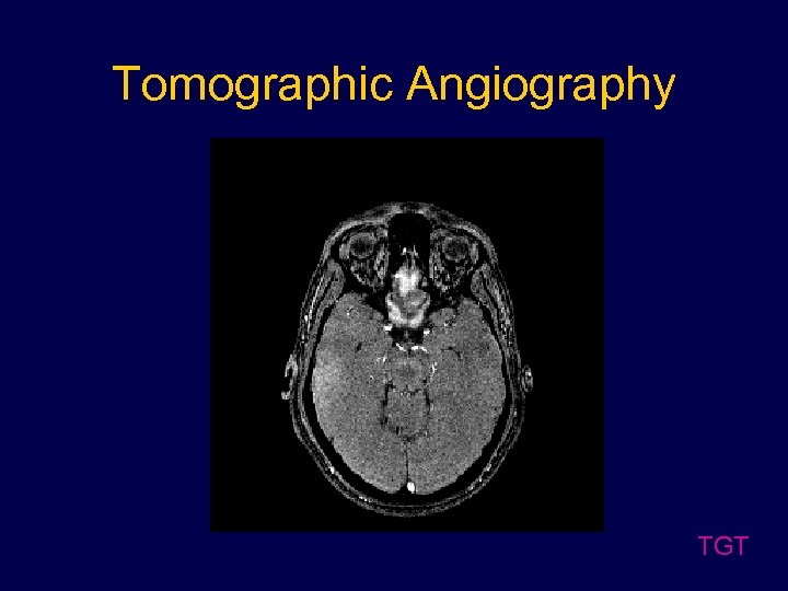Tomographic Angiography TGT 