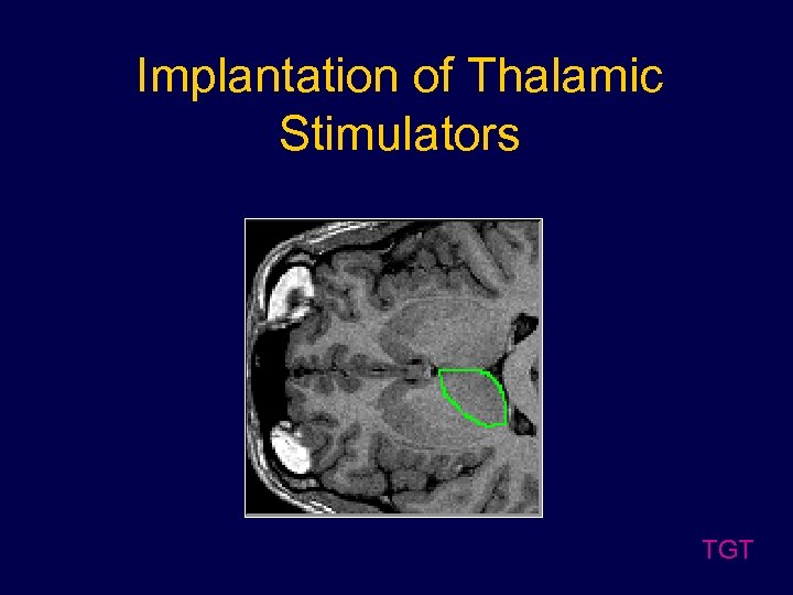Implantation of Thalamic Stimulators TGT 