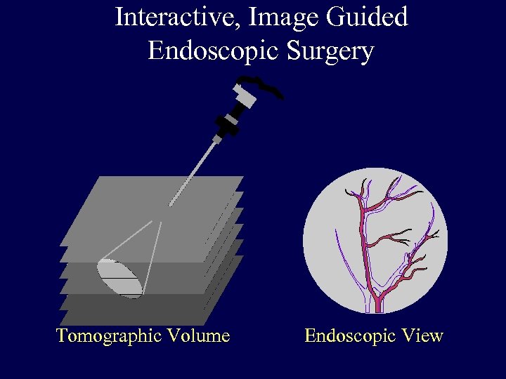 Interactive, Image Guided Endoscopic Surgery Tomographic Volume Endoscopic View 