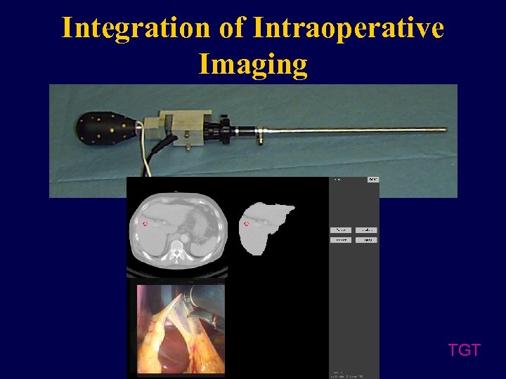Integration of Intraoperative Imaging TGT 