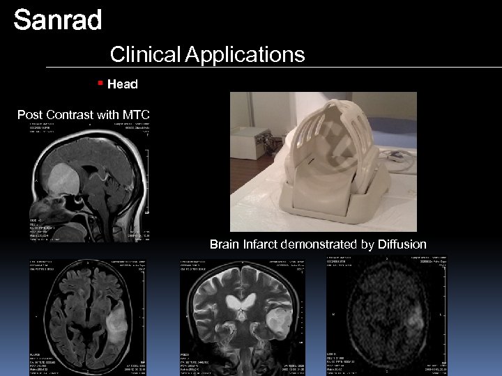 Sanrad Clinical Applications § Head Post Contrast with MTC Brain Infarct demonstrated by Diffusion