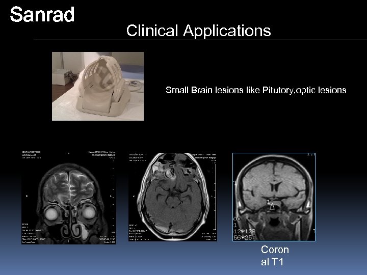Sanrad Clinical Applications Small Brain lesions like Pitutory, optic lesions Coron al T 1