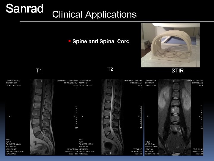 Sanrad Clinical Applications § Spine and Spinal Cord T 1 T 2 STIR 