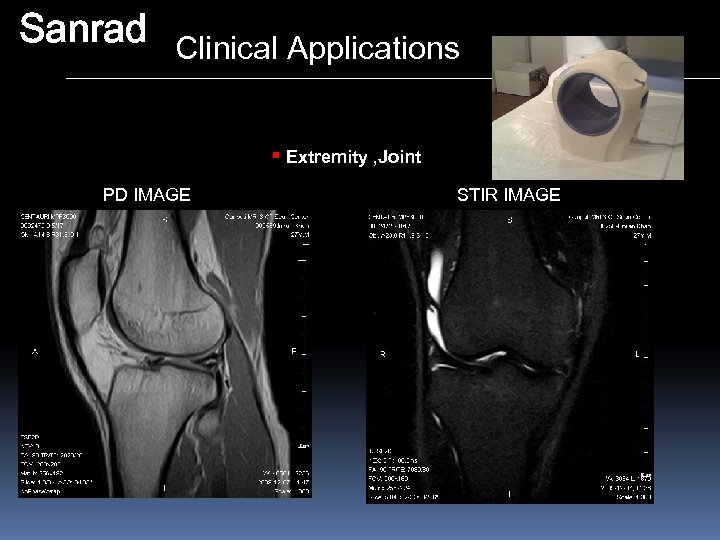 Sanrad Clinical Applications § Extremity , Joint PD IMAGE STIR IMAGE 
