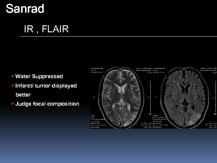 Sanrad IR , FLAIR § Water Suppressed § Infarct/ tumor displayed better § Judge