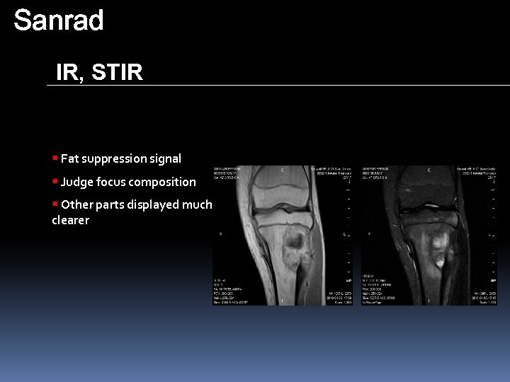 Sanrad IR, STIR § Fat suppression signal § Judge focus composition § Other parts