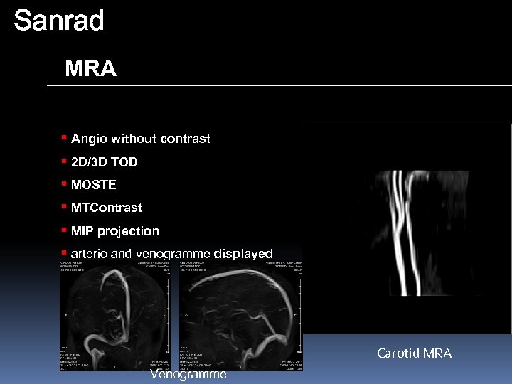 Sanrad MRA § Angio without contrast § 2 D/3 D TOD § MOSTE §