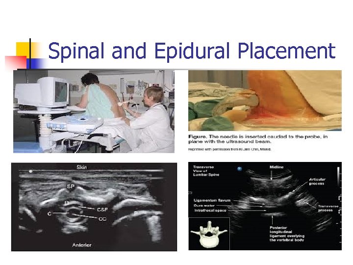 Spinal and Epidural Placement 