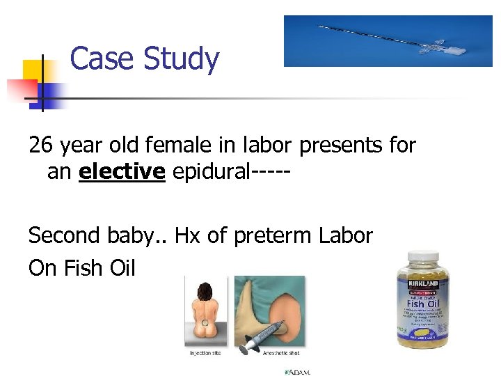 Case Study 26 year old female in labor presents for an elective epidural----Second baby.