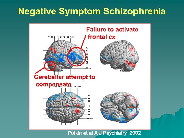 Negative Symptom Schizophrenia Failure to activate frontal cx Cerebellar attempt to compensate Potkin et