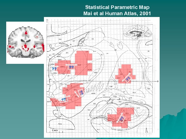 Statistical Parametric Map Mai et al Human Atlas, 2001 ? ? ? ? ?