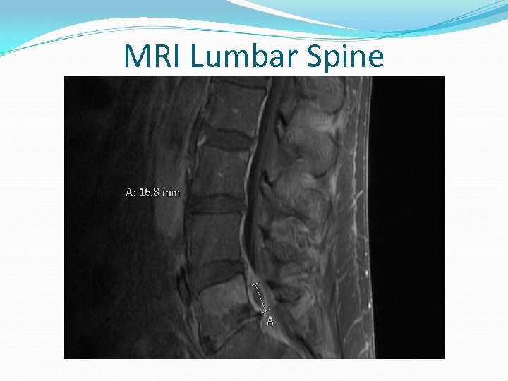 MRI Lumbar Spine 