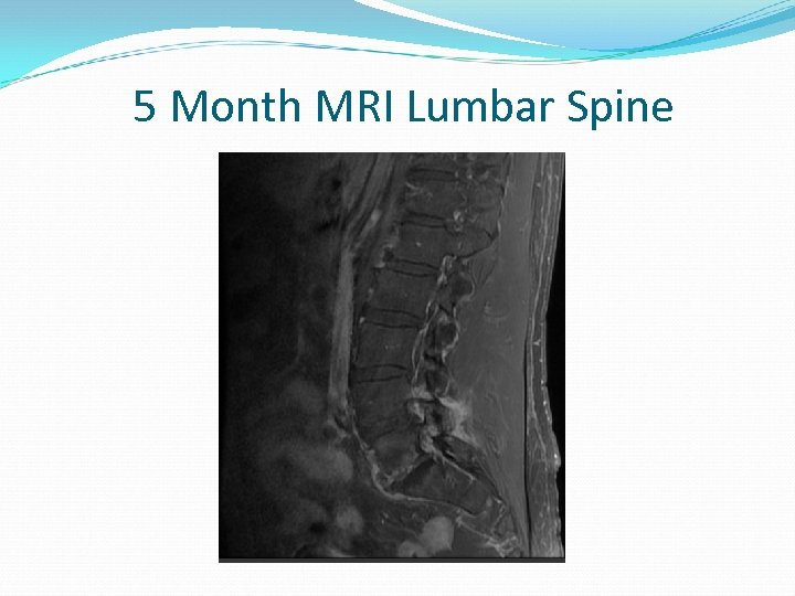 5 Month MRI Lumbar Spine 