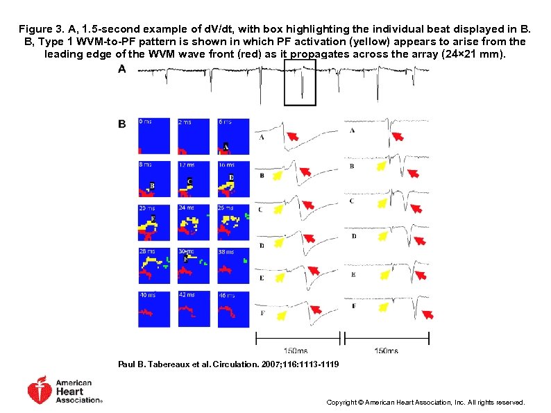 Figure 3. A, 1. 5 -second example of d. V/dt, with box highlighting the