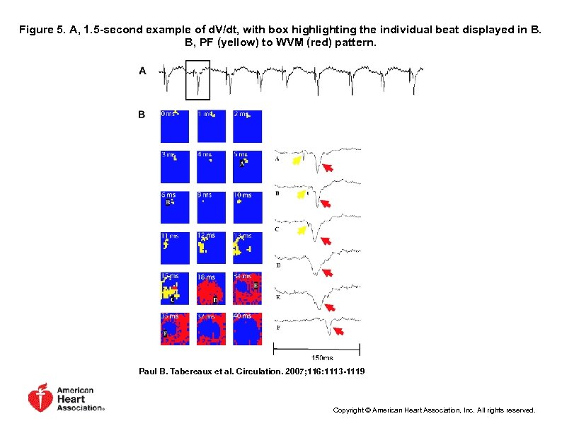 Figure 5. A, 1. 5 -second example of d. V/dt, with box highlighting the