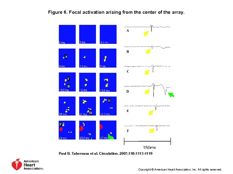 Figure 6. Focal activation arising from the center of the array. Paul B. Tabereaux