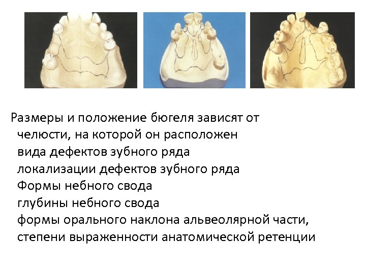 Нанесение рисунка каркаса бюгельного протеза на модель