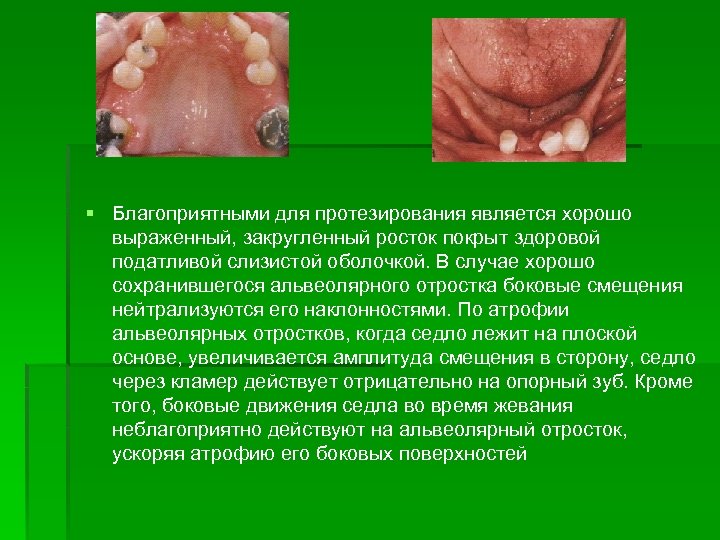 § Благоприятными для протезирования является хорошо выраженный, закругленный росток покрыт здоровой податливой слизистой оболочкой.