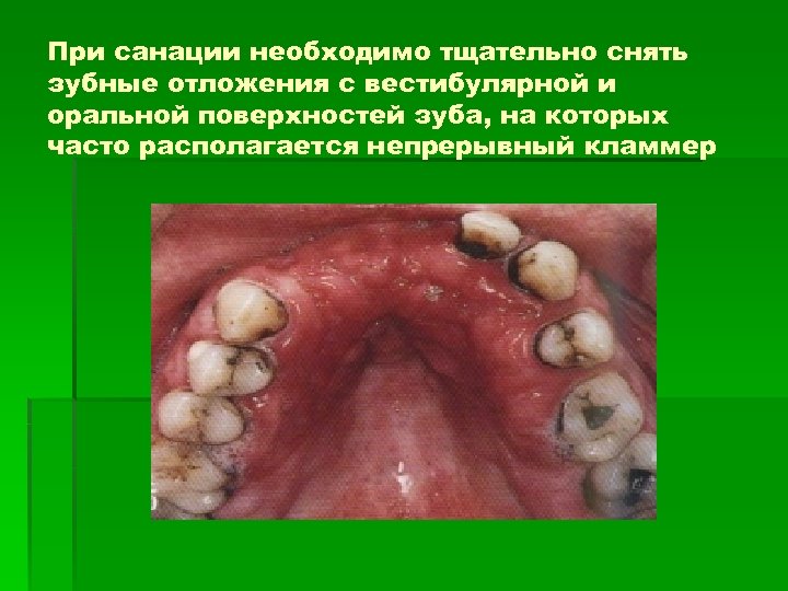 При санации необходимо тщательно снять зубные отложения с вестибулярной и оральной поверхностей зуба, на