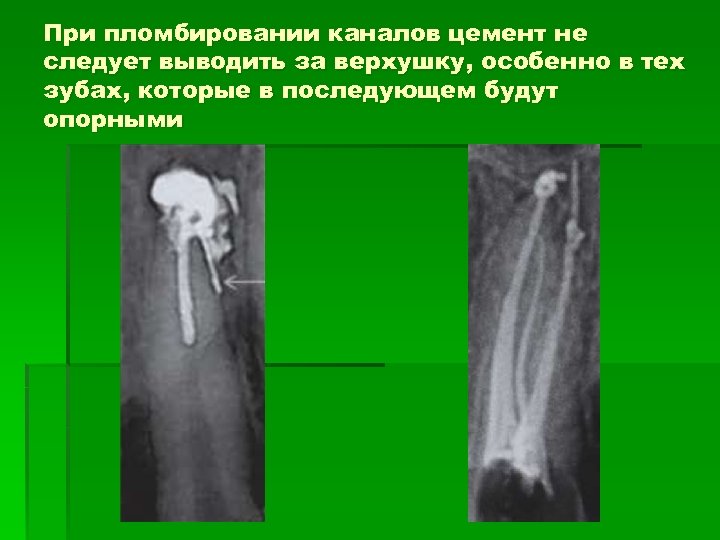 При пломбировании каналов цемент не следует выводить за верхушку, особенно в тех зубах, которые