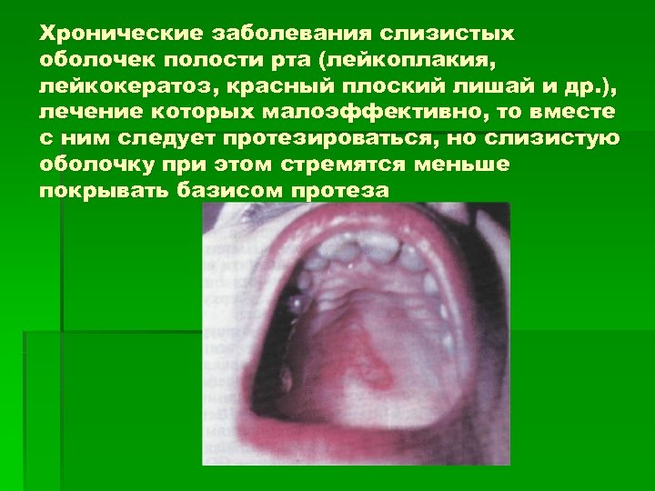 Хронические заболевания слизистых оболочек полости рта (лейкоплакия, лейкокератоз, красный плоский лишай и др. ),