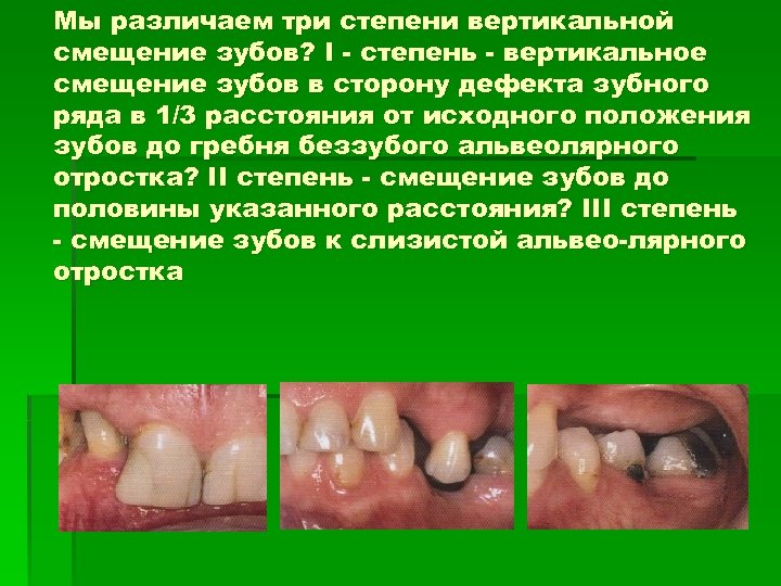 Мы различаем три степени вертикальной смещение зубов? I - степень - вертикальное смещение зубов