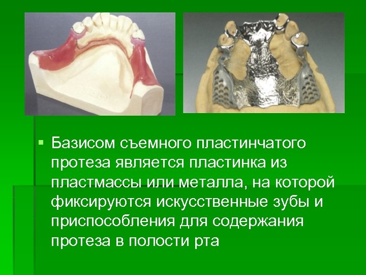 § Базисом съемного пластинчатого протеза является пластинка из пластмассы или металла, на которой фиксируются