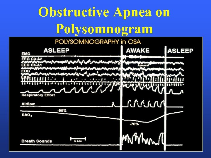 Obstructive Apnea on Polysomnogram 