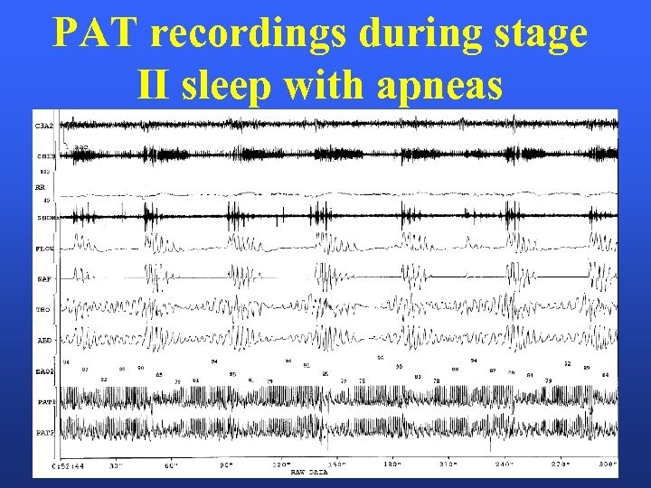 PAT recordings during stage II sleep with apneas 