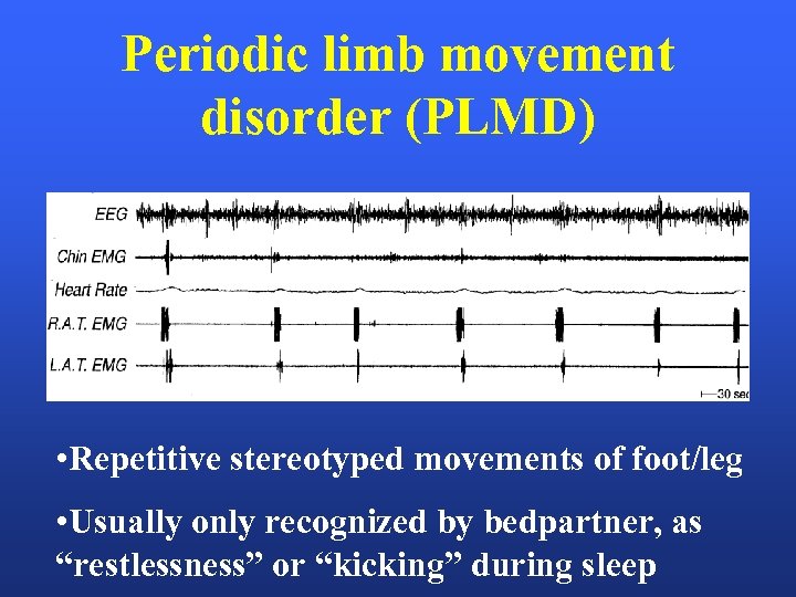 Periodic limb movement disorder (PLMD) • Repetitive stereotyped movements of foot/leg • Usually only