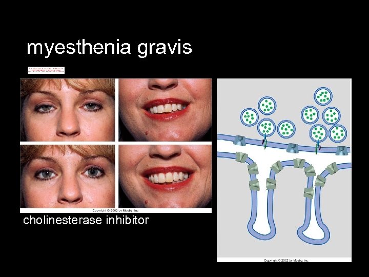 myesthenia gravis cholinesterase inhibitor 
