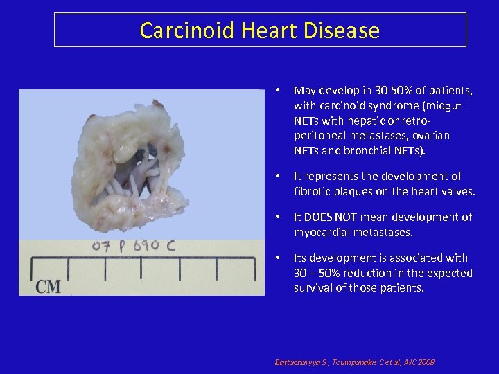 Carcinoid Heart Disease • May develop in 30 -50% of patients, with carcinoid syndrome