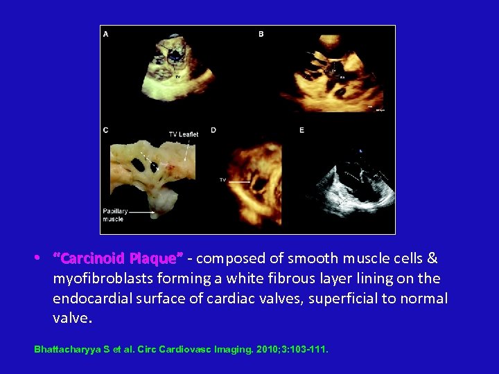  • “Carcinoid Plaque” - composed of smooth muscle cells & myofibroblasts forming a