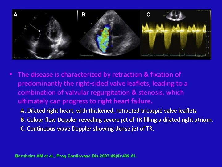  • The disease is characterized by retraction & fixation of predominantly the right-sided