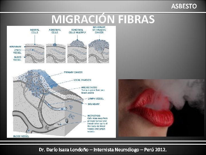 ASBESTO MIGRACIÓN FIBRAS Dr. Darío Isaza Londoño – Internista Neumólogo – Perú 2012. 