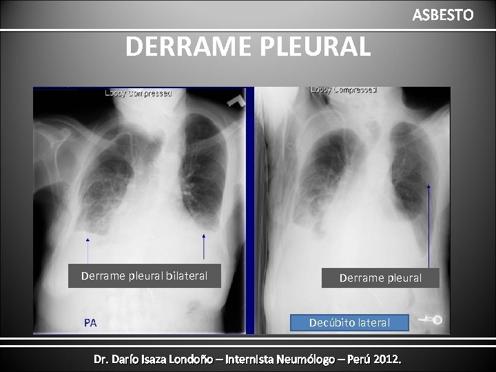 ASBESTO DERRAME PLEURAL Derrame pleural bilateral Derrame pleural Decúbito lateral Dr. Darío Isaza Londoño