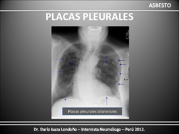 ASBESTO PLACAS PLEURALES Placas pleurales bilaterales Dr. Darío Isaza Londoño – Internista Neumólogo –