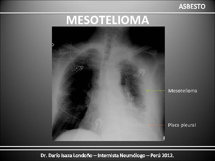 ASBESTO MESOTELIOMA Mesotelioma Placa pleural Dr. Darío Isaza Londoño – Internista Neumólogo – Perú