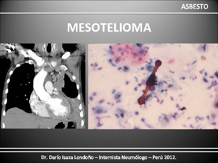 ASBESTO MESOTELIOMA Dr. Darío Isaza Londoño – Internista Neumólogo – Perú 2012. 