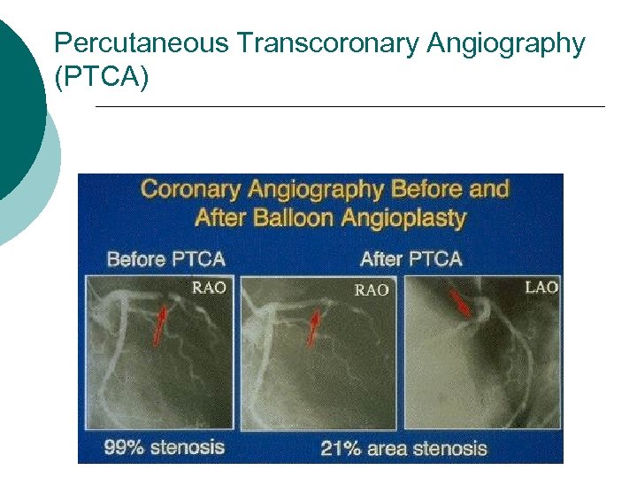 Percutaneous Transcoronary Angiography (PTCA) 