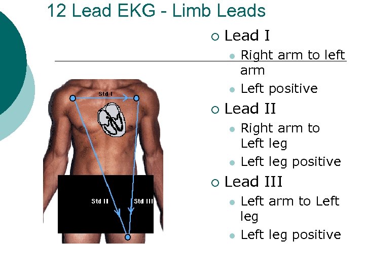 12 Lead EKG - Limb Leads ¡ Lead I l l ¡ Lead II